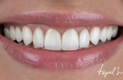 The Veneers Treatment Process
