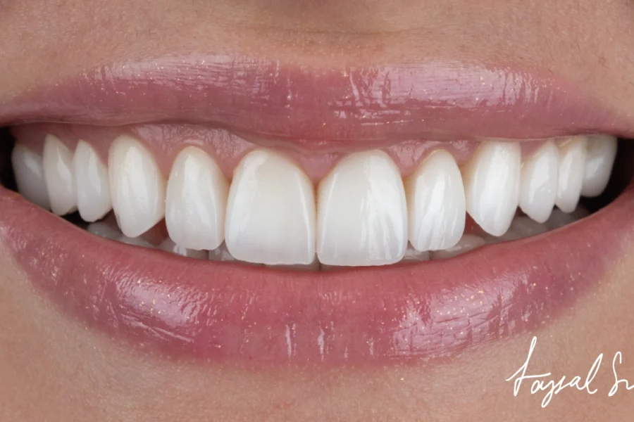 The Veneers Treatment Process